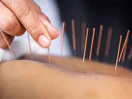 How acupuncture can help treat insomnia
